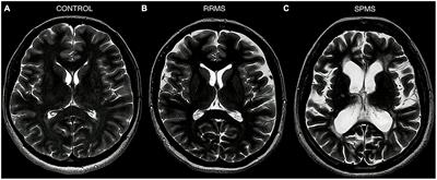 Neurodegeneration and its potential markers in the diagnosing of secondary progressive multiple sclerosis. A review